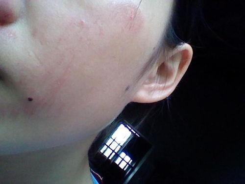 脸上疤痕照片,揭秘脸上疤痕背后的故事